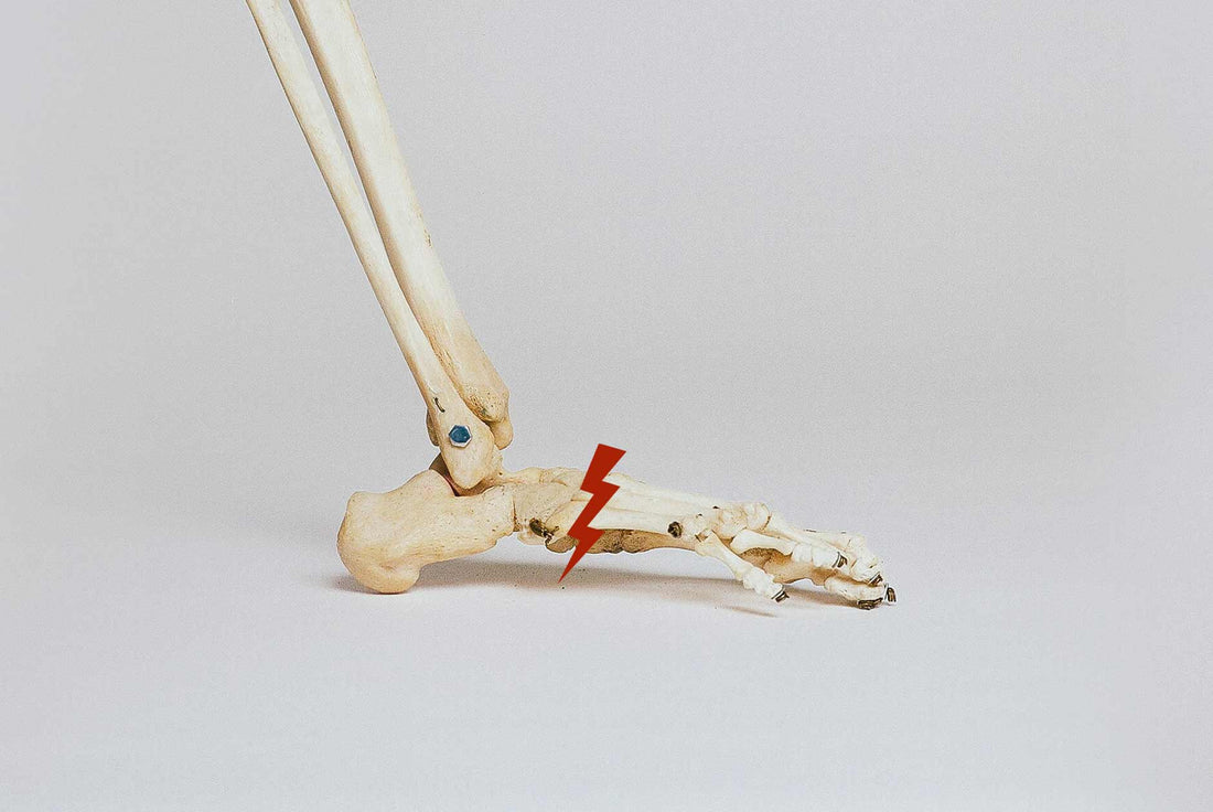 Qu’est-ce qu’une fracture ?