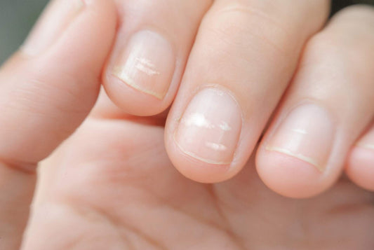 Raisons et traitements des taches blanches sur les ongles